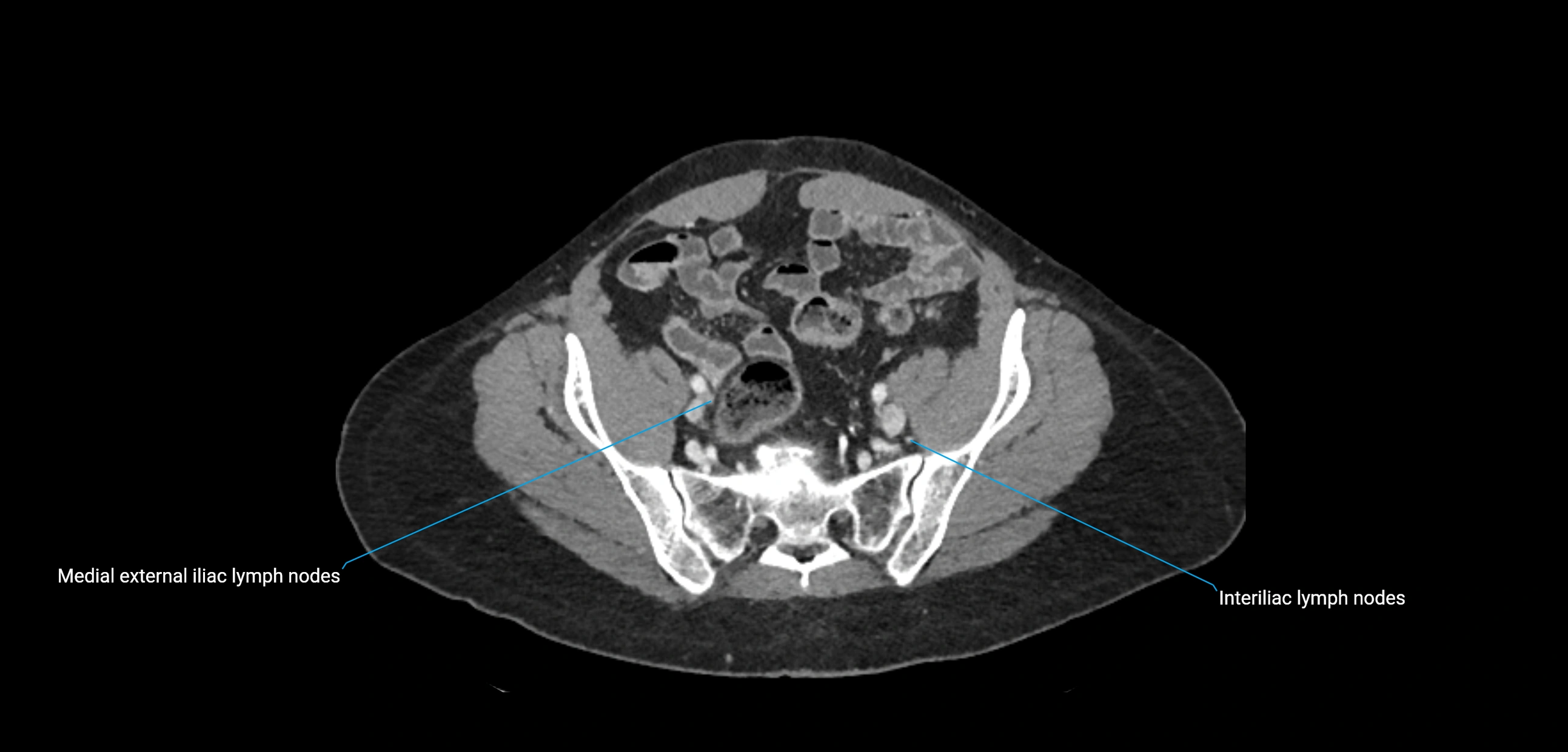 CT ct abdominal lymph nodes  axial cross sectional anatomy  enchanced radiology image -img-00002-00331.webp
